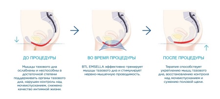 Кресло BTL Emsella - аппарат высокоинтенсивной магнитотерапии