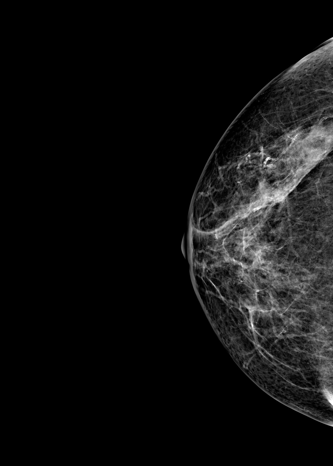 Цифровой маммограф Brestige Expert Indirect