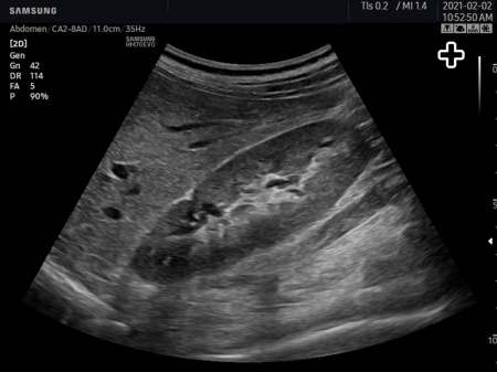 Аппарат УЗИ Samsung Medison HM70 EVO