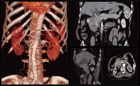 Компьютерный томограф NeuViz 64 Neusoft