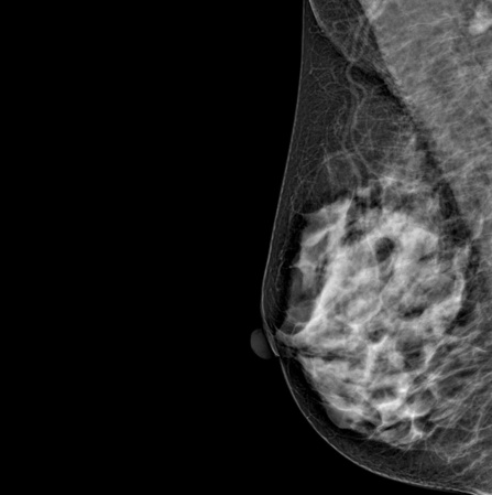 Цифровой маммограф Genoray DMX-600