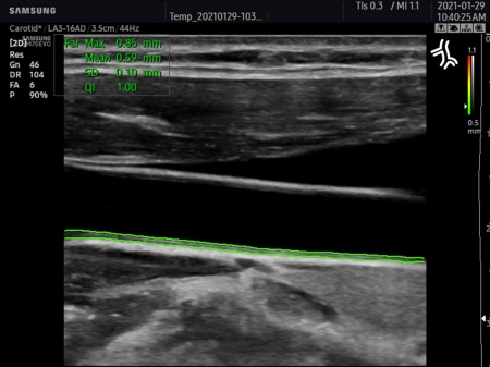 Аппарат УЗИ Samsung Medison HM70 EVO