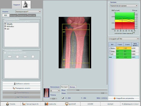 Рентгеновский костный денситометр Stratos DMS